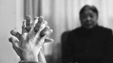 安徽一女子患怪病身高缩减36厘米