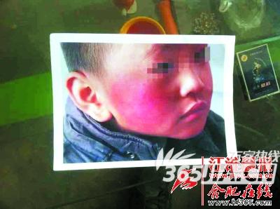 小孩右脸红肿
